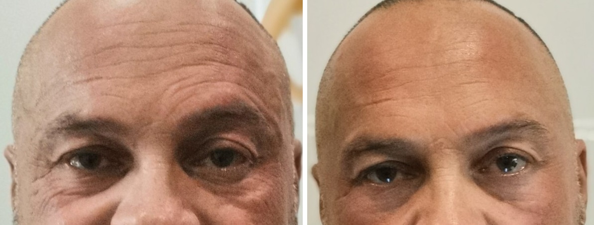 photorajeunissement-ride-ridules-contour-yeux-front-avant-apres 7 traitements